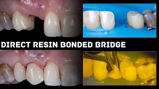 Direct Resin Bonded Bridge [upl. by Nnylecyoj918]