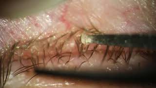 Severe Demodex Removal on 75yearold [upl. by Nerrej]