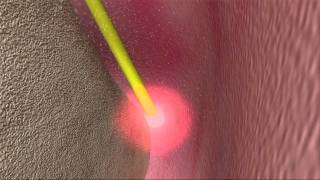 Laser Periodontal Therapy  WPT™ Animation [upl. by Aidua]