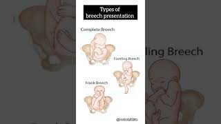 Types of breech presentation  viralvideo breech [upl. by Kyriako]