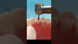 Crown preparation  Canine teeth teethstreet dentalprocedure dental [upl. by Ephrem747]