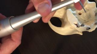 engaging angled multi unit abutments Neodent mini conical [upl. by Anevad]