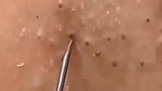 14 minutes blackheads smoothly removed [upl. by Madden]