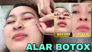 ALAR BOTOX PROCEDURE AGAIN  PHILIPPINES [upl. by Stratton]