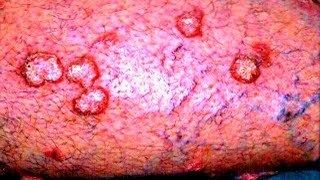 Lichen Planus  Medical PowerPoint Presentation [upl. by Botti]