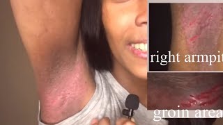 How I treat my inverse Psoriasis [upl. by Hilleary]