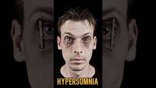 Hypersomnia somnia neend facts pakistan india science research night [upl. by Navetse]