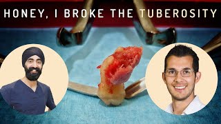 How To Manage a Maxillary Tuberosity Fracture  Oral Surgery Complications [upl. by O'Rourke]