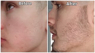 Minoxidil Beard Growth  3 Month Transformation  BEFORE and AFTER [upl. by Melc]