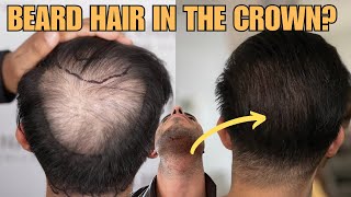 Can You Transplant Beard Hair In The Crown Dr Felipe Pittella Answers [upl. by Curtis199]