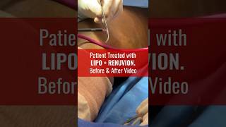 Amazing Patient Results after Liposuction amp Renuvion [upl. by Batsheva]