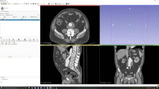 3D Slicer Tutorial 2 Manual segmentation Thresholding [upl. by Bohrer780]