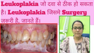 White Patch in mouthLeukoplakia amp its typesWhich Leukoplakia is dangerous amp transform to Cancer [upl. by Ainimreh]