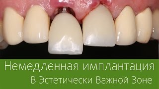 Немедленная Имплантация в Эстетически Важной Зоне [upl. by Cl]