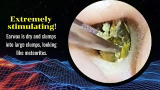 Dry clumpy earwax [upl. by Severen831]