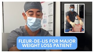 FleurDeLis for major weight loss patient  Zuri Plastic Surgery [upl. by Rodgers]