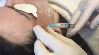 Sculptra Temples  Facial Structure Defining Contouring  Los Angeles [upl. by Aicilas447]