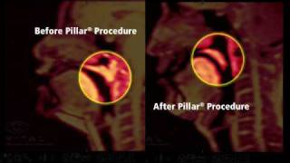 Pillar Procedure MRI  Proliance Eastside Ear Nose amp Throat [upl. by Byrd]