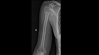 Hertels criteria for proximal humerus fractures everything you need to know with XRay examples [upl. by Nivak]