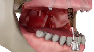 Straumann Pro Arch Step by Step Overview [upl. by Klapp]