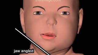 Hemifacial Craniofacial Microsomia Animation by Cal Shipley MD [upl. by Nhguavad]