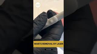 Safe and Effective Wart Removal Treatment with Dr Ahmad [upl. by Clauddetta874]