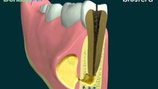 Ascesso la terapia endodontica [upl. by Kym]