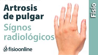 Rizartrosis o artrosis del pulgar  Signos radiológicos [upl. by Dranrev647]