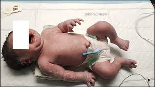 Medical Education Video Neonatology Neonatal Brachial Plexus Palsy Erb Palsy [upl. by Aileen]