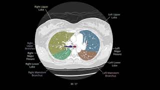 How to read HRCT chest axial view with voice [upl. by Dami899]