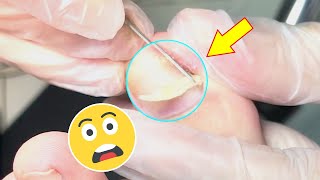 Ingrown toenail removal treatment [upl. by Bobbye]