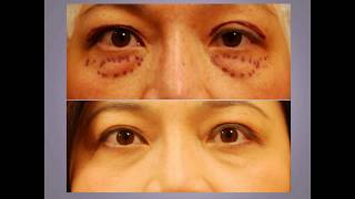 ChaseLayMD Ptosis Droopy Eyelid Surgery [upl. by Riess]