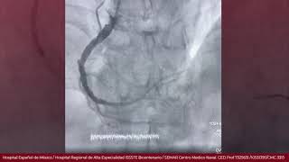 Angioplastia Coronaria Derecha [upl. by Alderman]