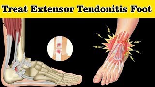 How to Treat Extensor Tendonitis Foot  Extensor Tendonitis Foot Treatment [upl. by Animaj]