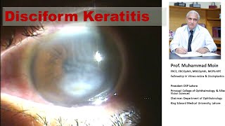 Disciform Keratitis [upl. by Obel]