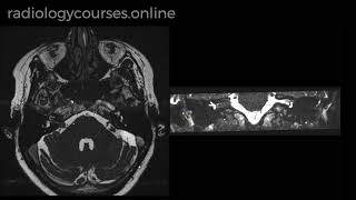 Vestibular Schwannoma [upl. by Jahdai665]