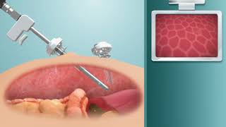 Animation of ClickClean Laparoscope Lens Cleaning Device [upl. by Sherris448]