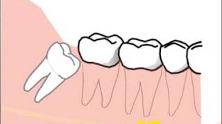 alte Version Erklärung spezieller Probleme und Risiken bei der Weisheitszahnentfernung [upl. by Laup]