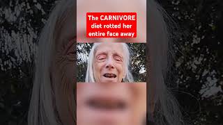 The CARNIVORE diet rotted her entire face away carnivorediet carnivore ketodiet [upl. by Alakim]