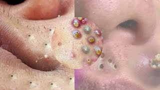 cleaning satisfying blackhead removalFace pimple removal pimple25975 [upl. by Essined343]