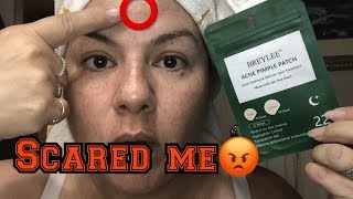 NO Acne Pimple Patch Review [upl. by Bilicki]