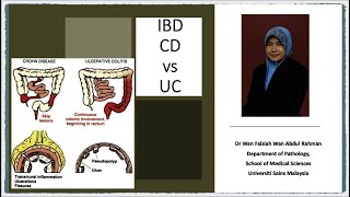 IBD Pathology of Crohn Disease And Ulcerative Colitis [upl. by Server]