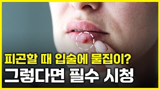 헤르페스HSV 예방 방법과 치료 방법은 아는 만큼 보인다 [upl. by Cioffred18]