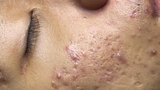 ACNE TREATMENT VU QUYNH MI Acne On Boys Nose 2024 [upl. by Lundeen44]