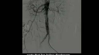 Angiography  Abdominal aorta [upl. by Haggerty405]