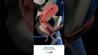 Dilation And Curettage DampC  Fertility Treatment ↪3D Medical Animation Shorts DilationampCurettage [upl. by Parhe]