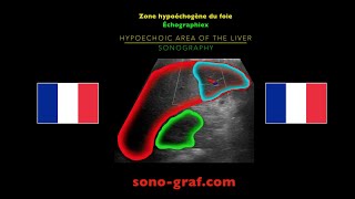 Échographie  Zone hypoéchogène du foie [upl. by Erdnaxela]