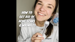 HOW TO GET RID OF ACNE SCARS amp WRINKLES  Using RF AMP MD Roller amp Intensive Renewing Serum [upl. by Brigitta708]