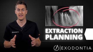 How To Extract Teeth Successfully Every Time  OnlineExodontiacom [upl. by Belloir]