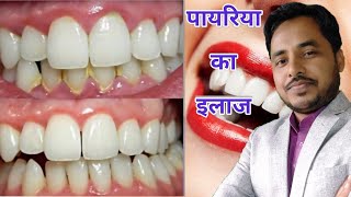 Payriya ka ilaj  Treatment of gingivitis amp periodontitis [upl. by Attegroeg346]